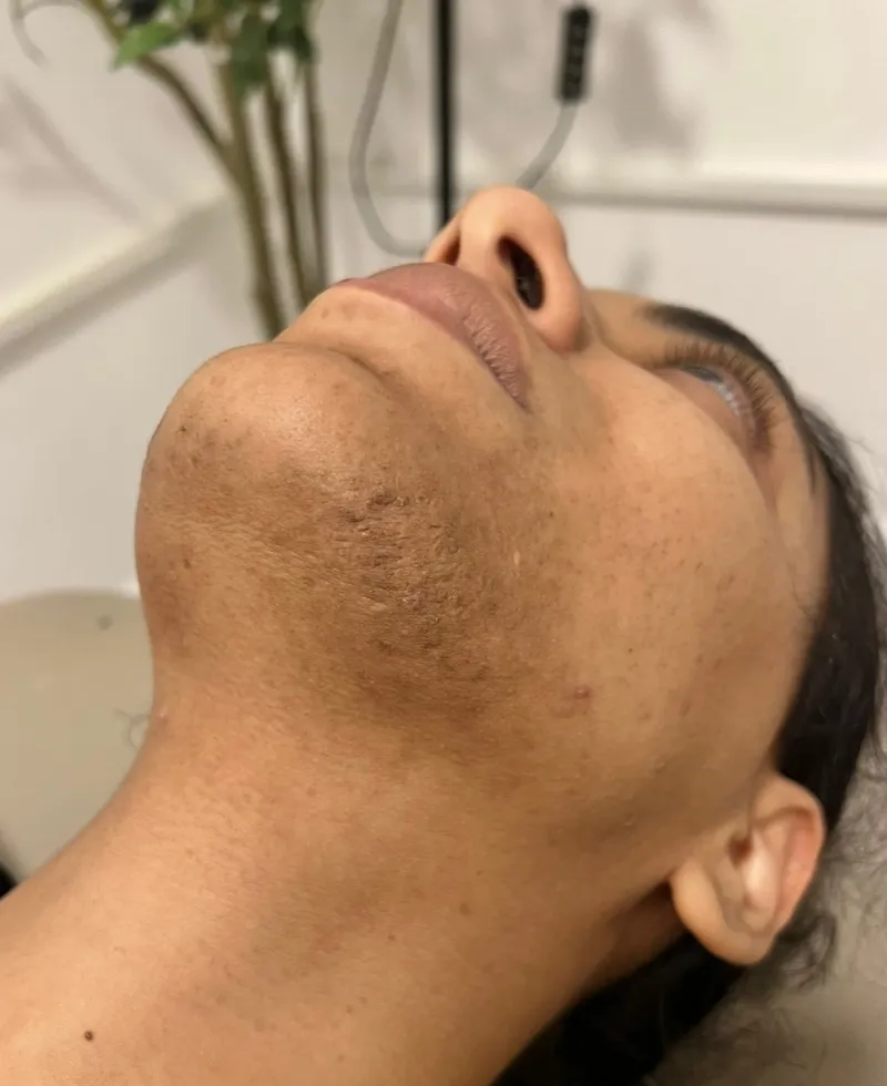 Laser hair removal, chin, after