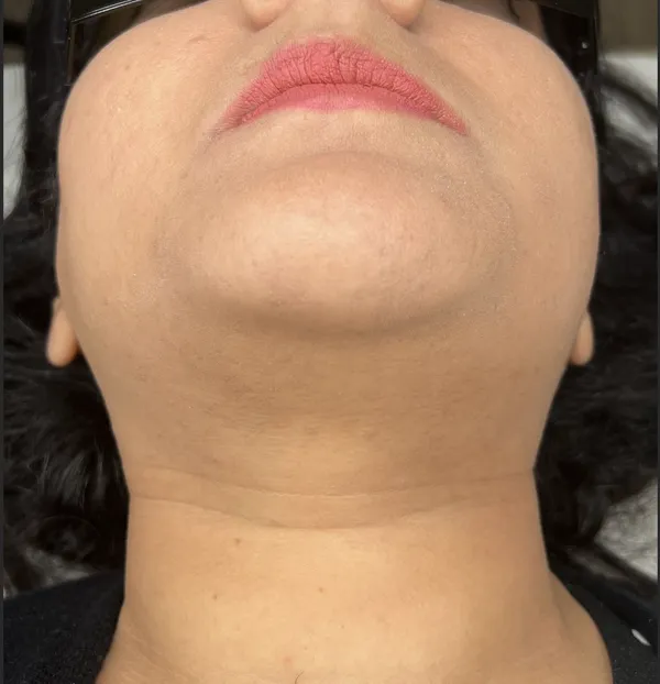 Laser hair removal, chin and upper lip, after