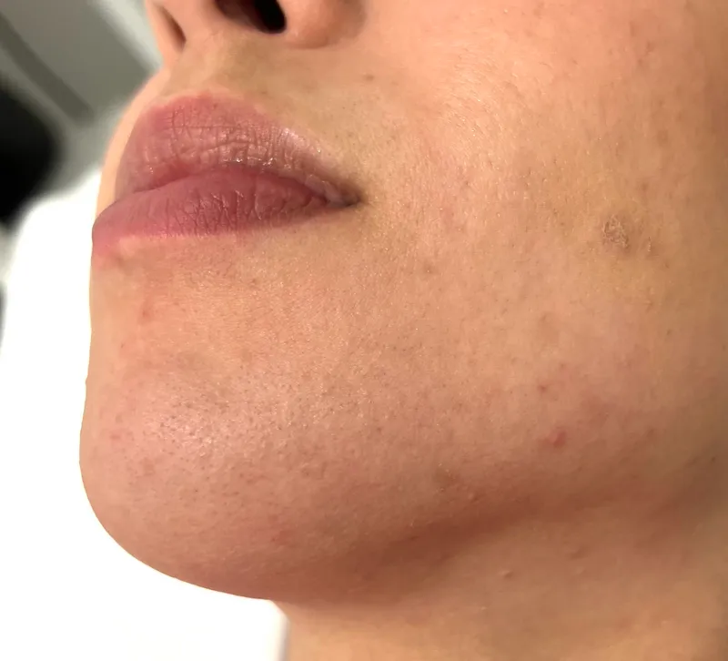 Laser hair removal, chin, after