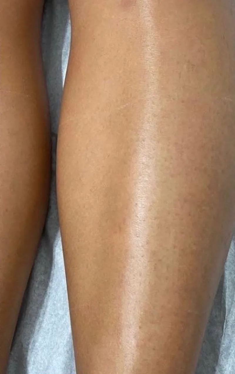 Laser hair removal, full legs, after