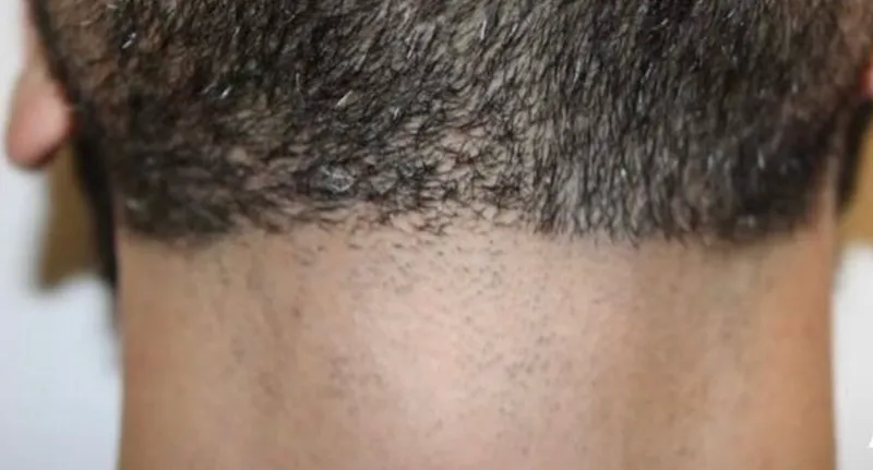 Laser hair removal, neck, after