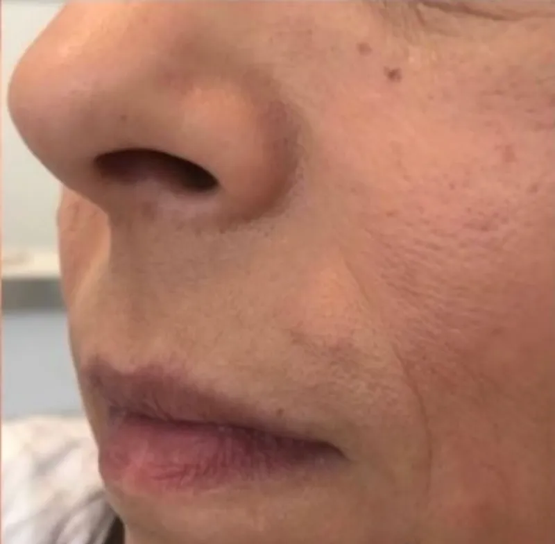 Laser hair removal, upper lip, after