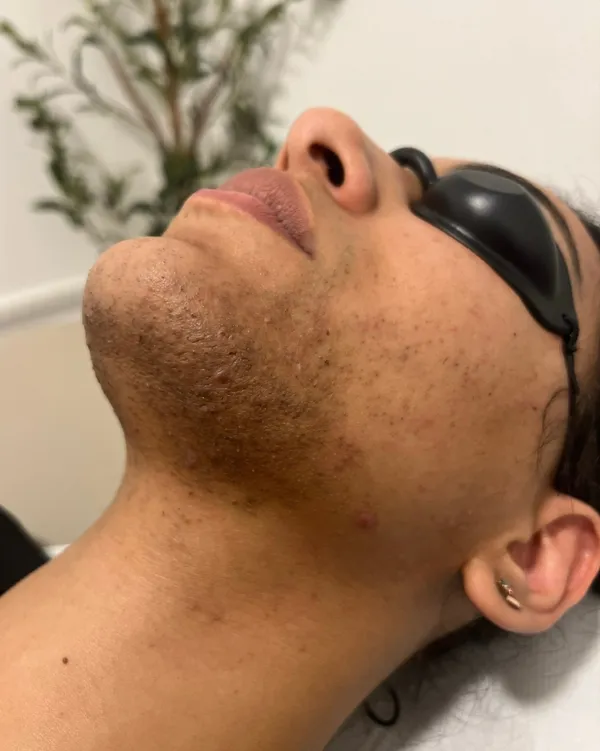 Laser hair removal, chin, before