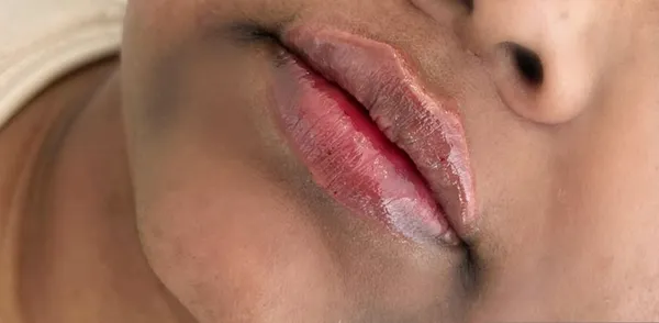 Lip filler, 1ml, after