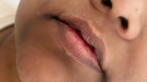 Lip filler, 1ml, before
