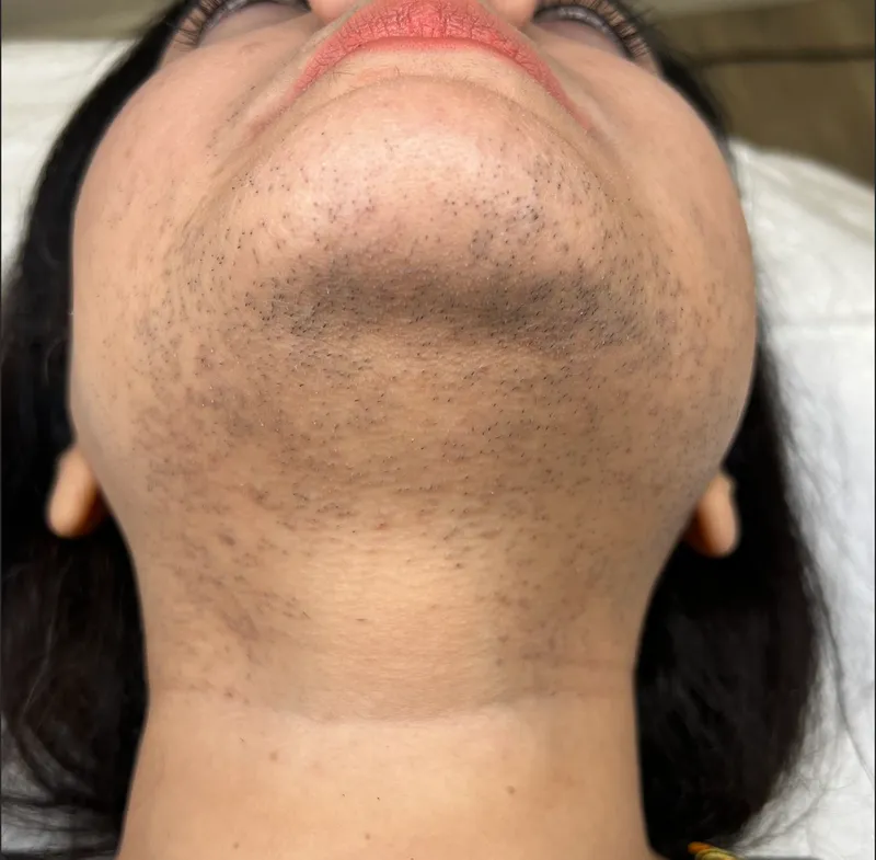 Laser hair removal, chin and upper lip, before