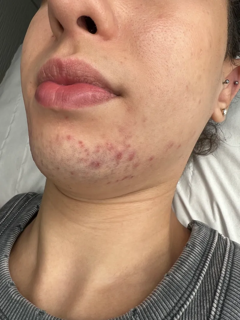 Laser hair removal, chin, before
