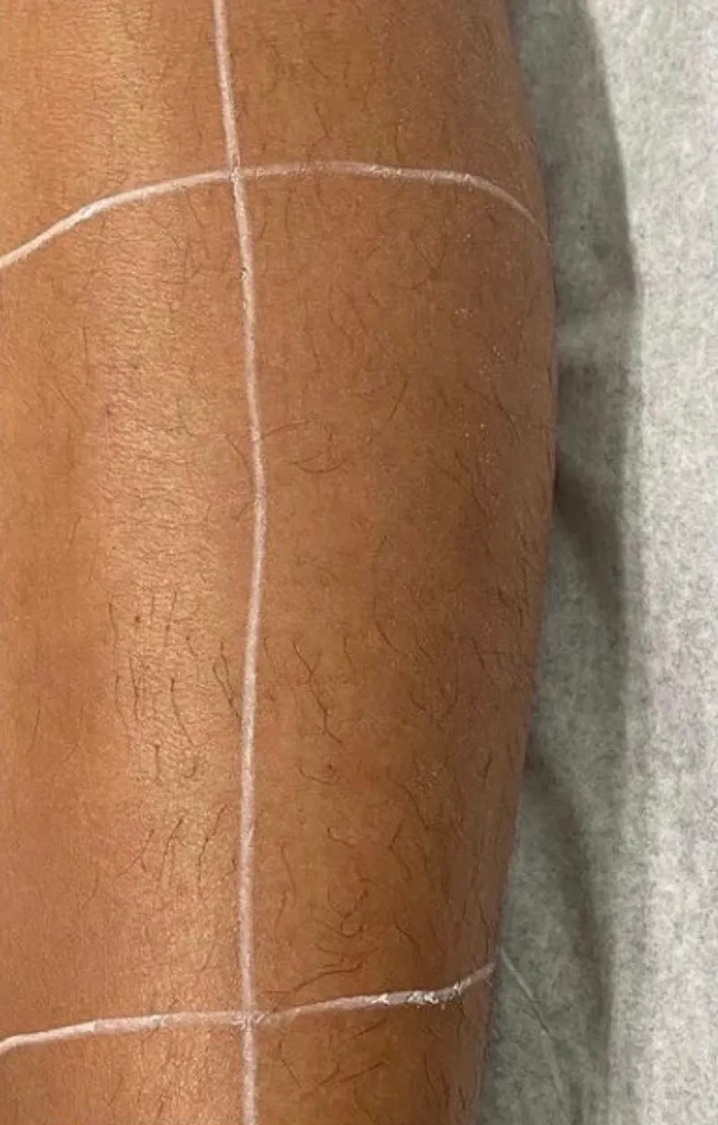 Laser hair removal, full legs, before