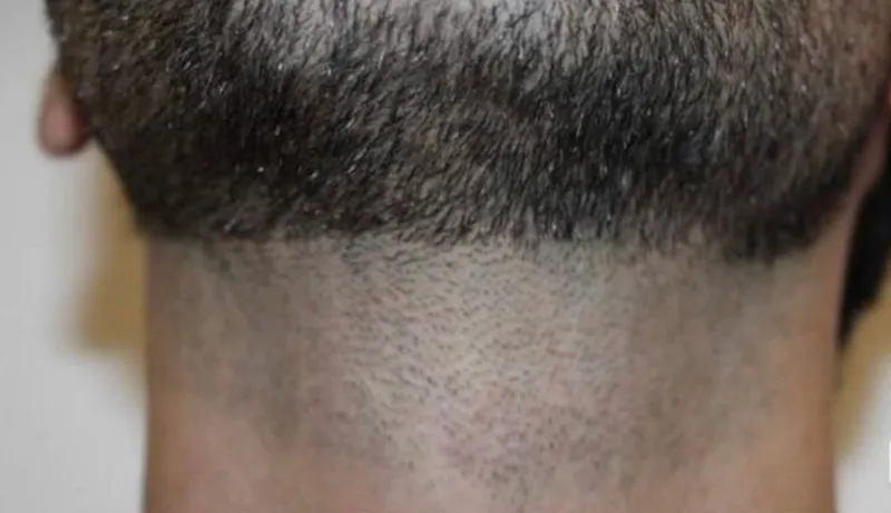 Laser hair removal, neck, before
