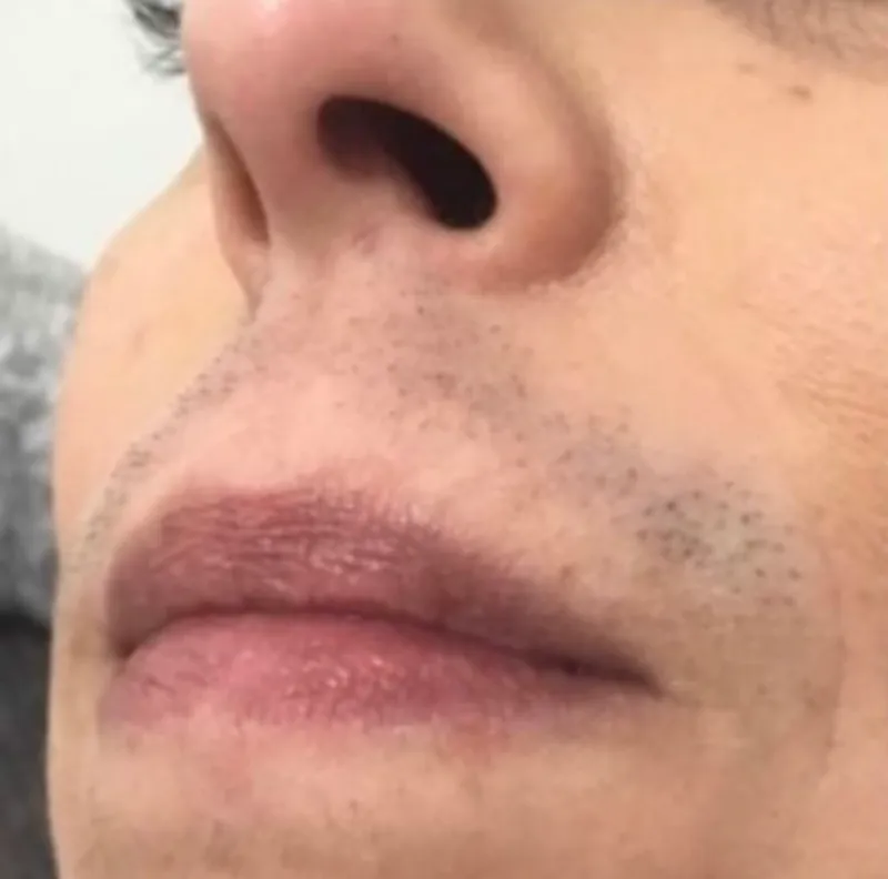 Laser hair removal, upper lip, before